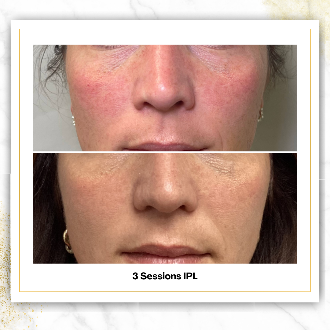 IPL Photofacial in San Antonio | From $125 | DaVida