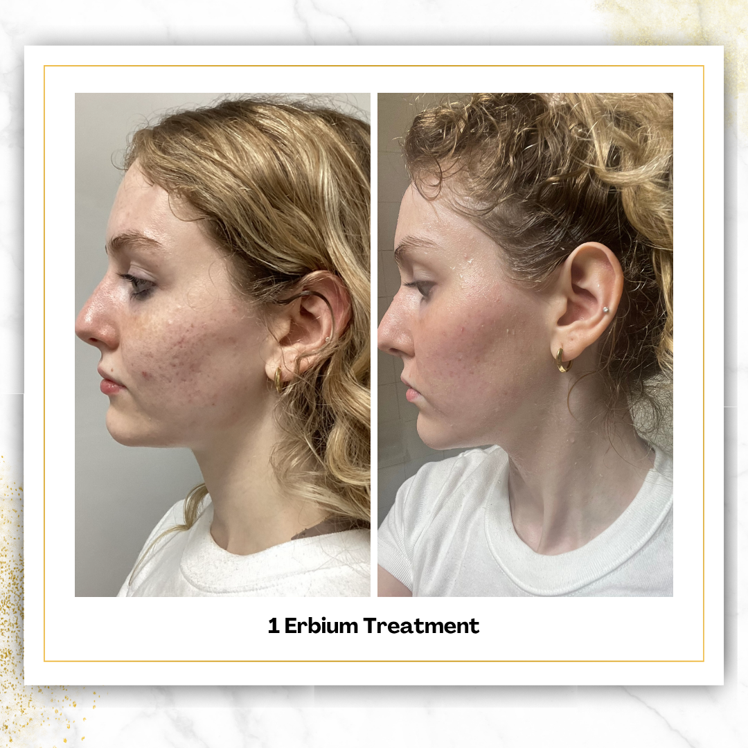 Erbium (Laser Skin Resurfacing)