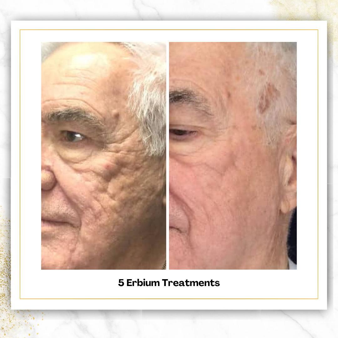 Erbium (Laser Skin Resurfacing)
