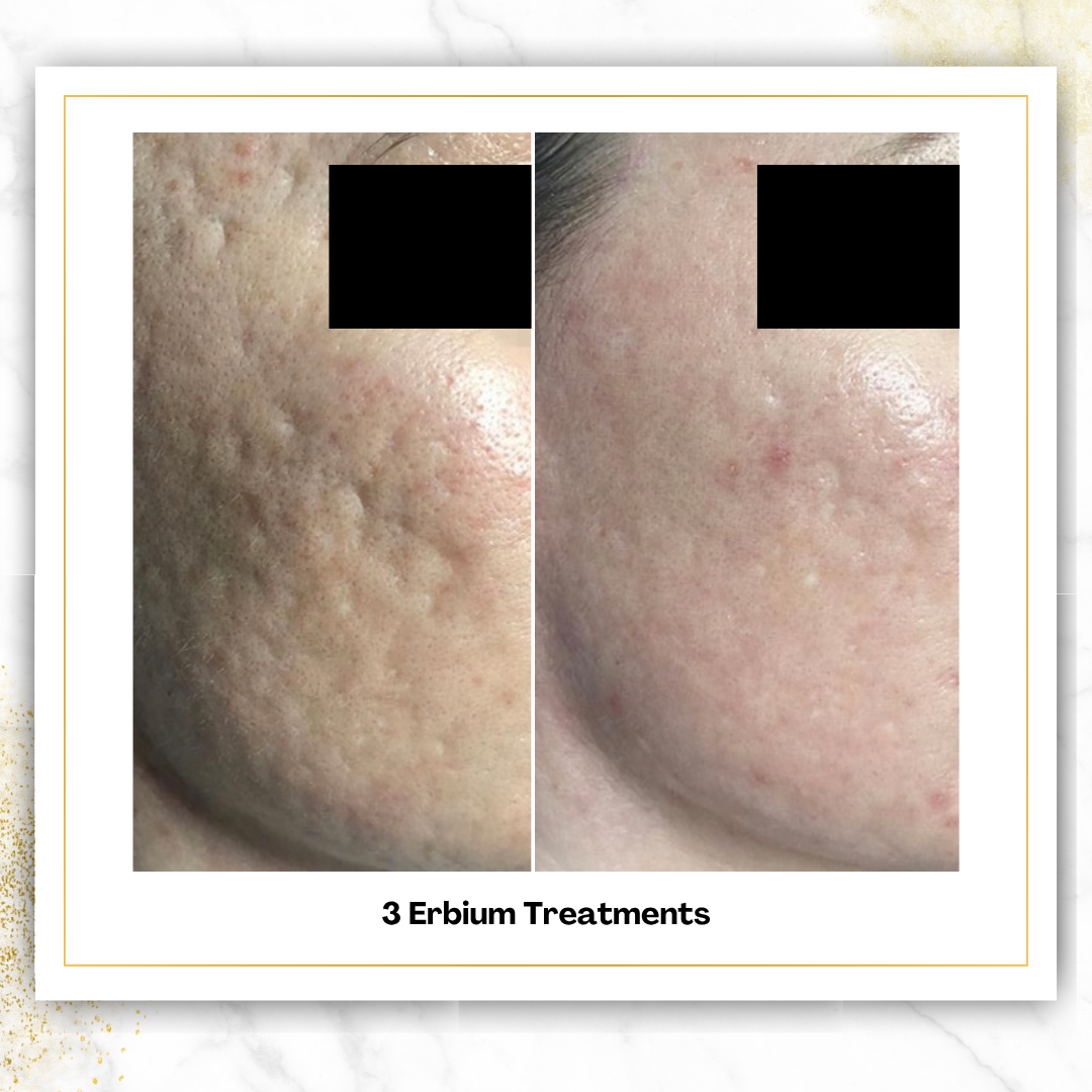 Erbium (Laser Skin Resurfacing)