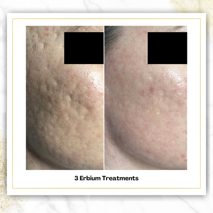 Erbium (Laser Skin Resurfacing)