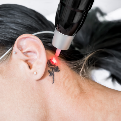 Laser Tattoo Removal in San Antonio | From $85 | DaVida