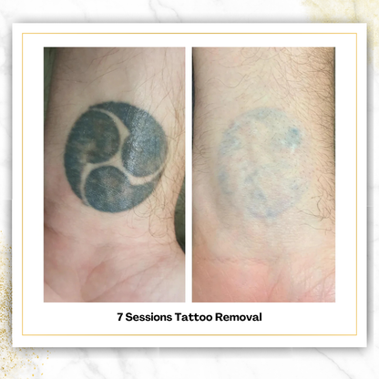 Laser Tattoo Removal in San Antonio | From $85 | DaVida