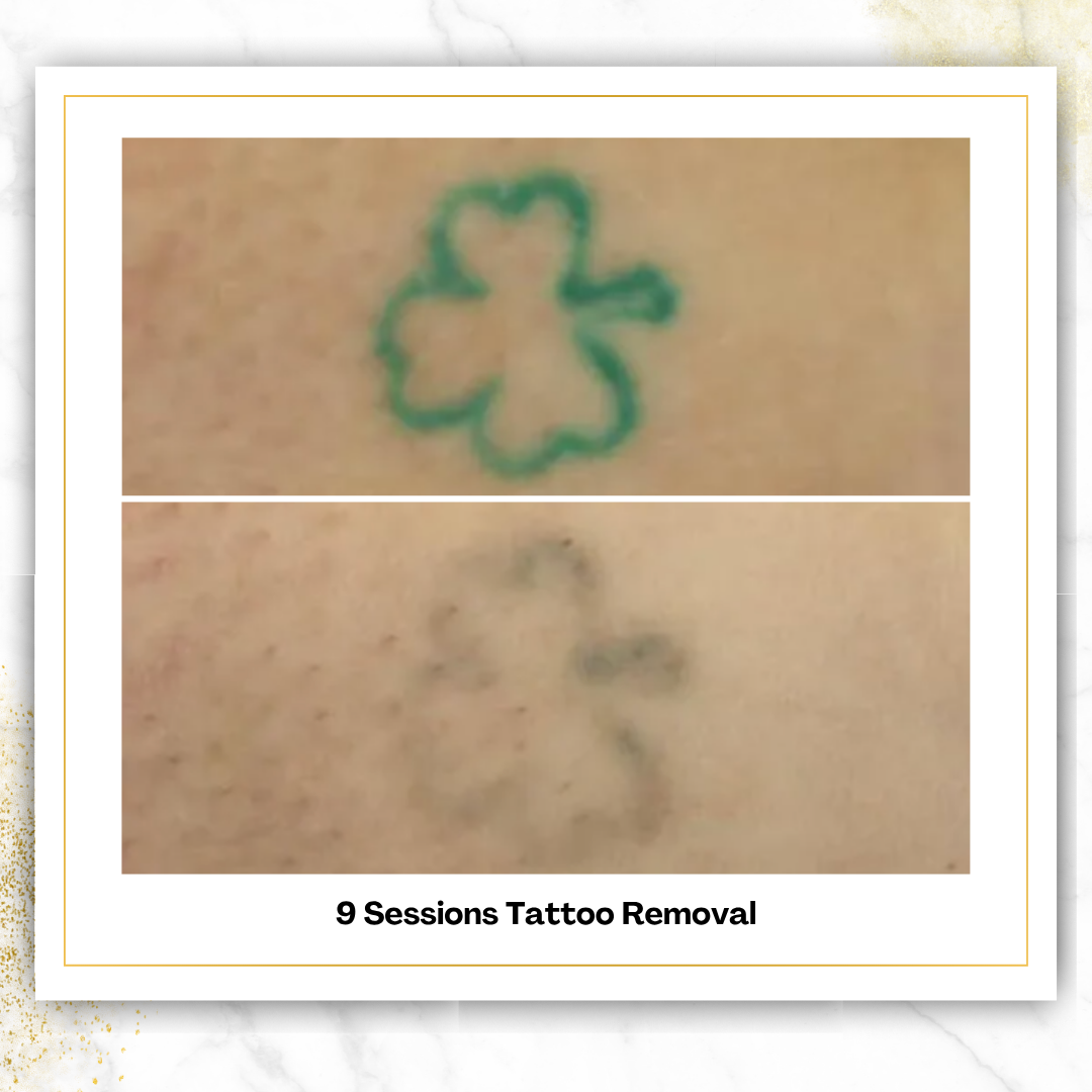 Laser Tattoo Removal in San Antonio | From $85 | DaVida