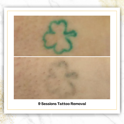 Laser Tattoo Removal in San Antonio | From $85 | DaVida