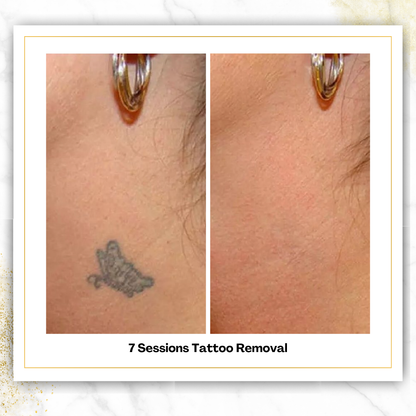 Laser Tattoo Removal in San Antonio | From $85 | DaVida