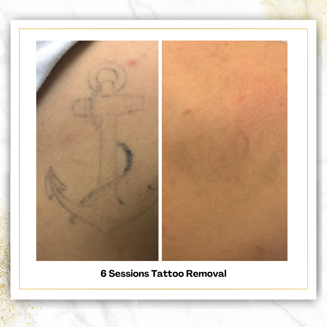 Laser Tattoo Removal in San Antonio | From $85 | DaVida