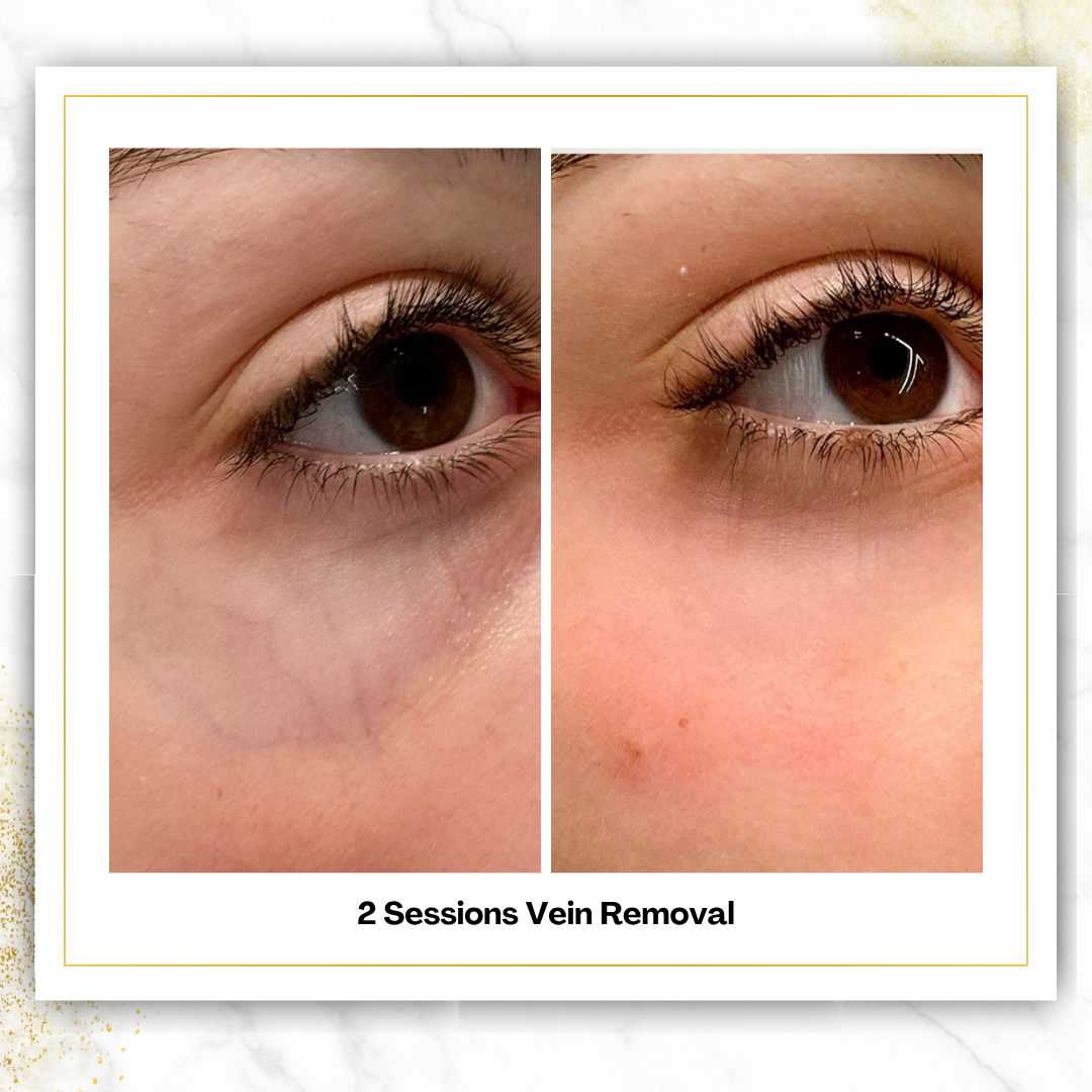 Spider Vein Removal in San Antonio | $200 | DaVida