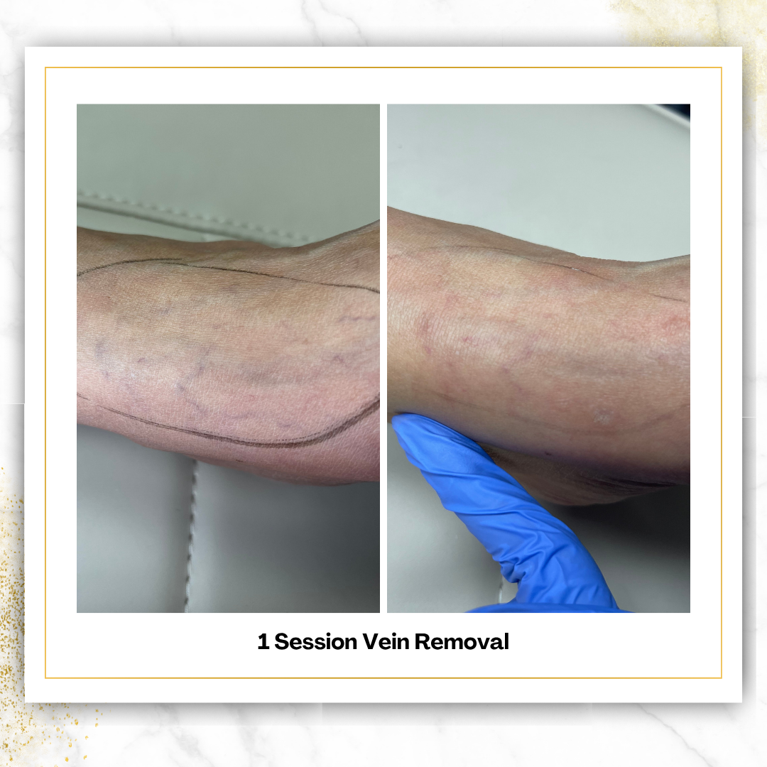 Spider Vein Removal in San Antonio | $200 | DaVida