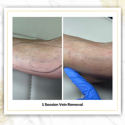 Spider Vein Removal in San Antonio | $200 | DaVida