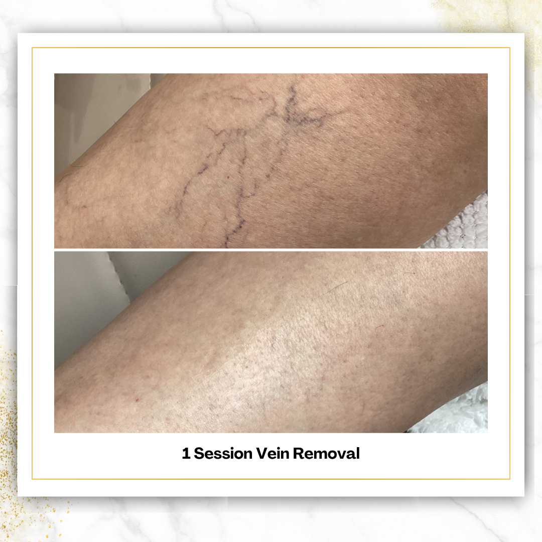 Spider Vein Removal in San Antonio | $200 | DaVida