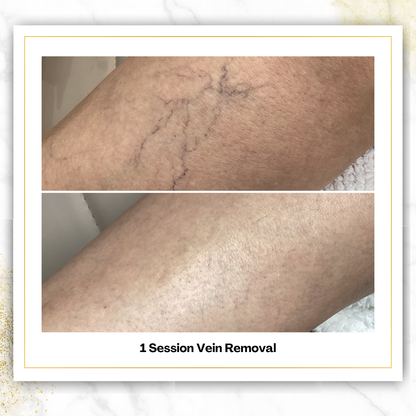 Spider Vein Removal in San Antonio | $200 | DaVida
