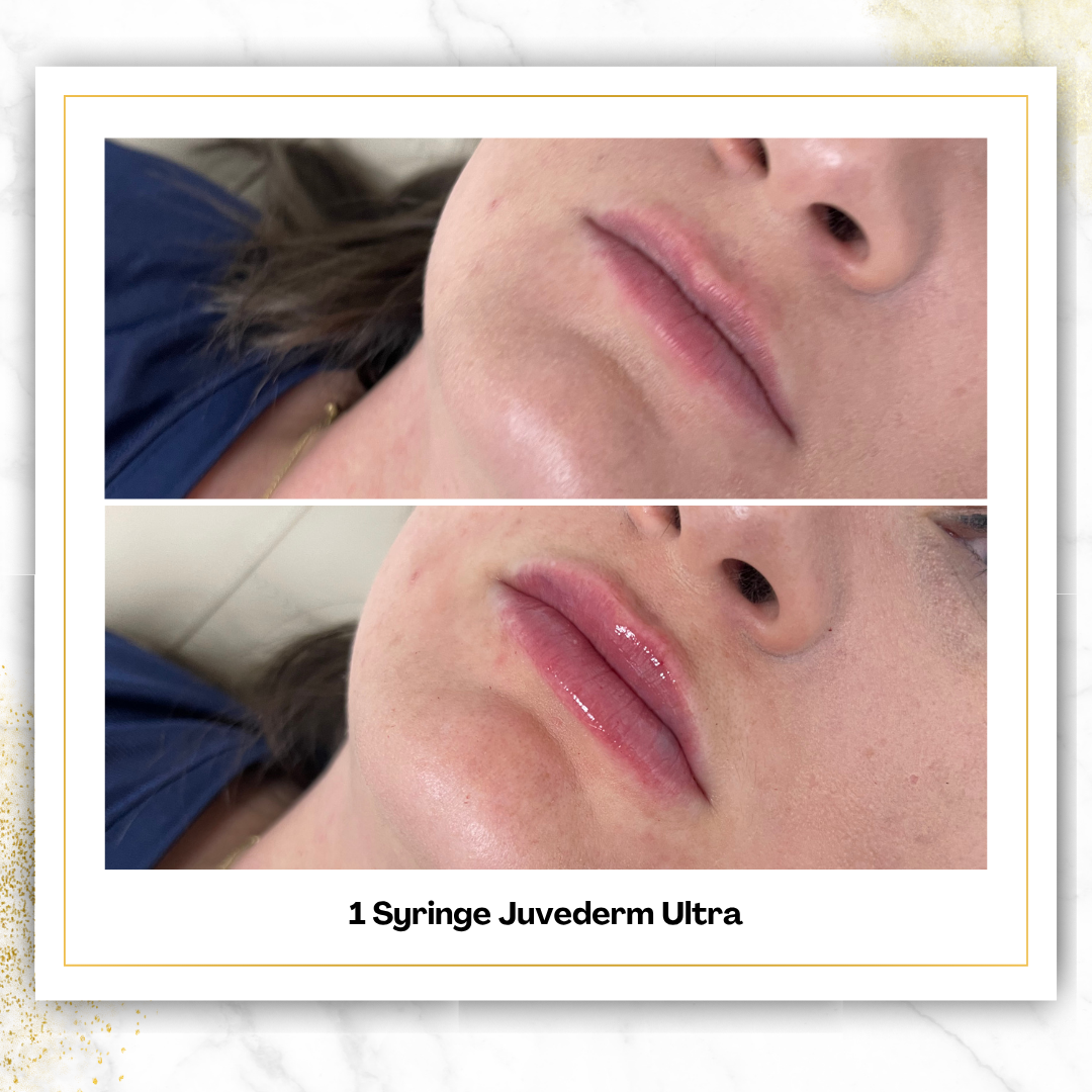 Juvederm Ultra Lip Filler in San Antonio | $500 | DaVida