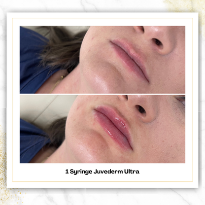Juvederm Ultra Lip Filler in San Antonio | $500 | DaVida