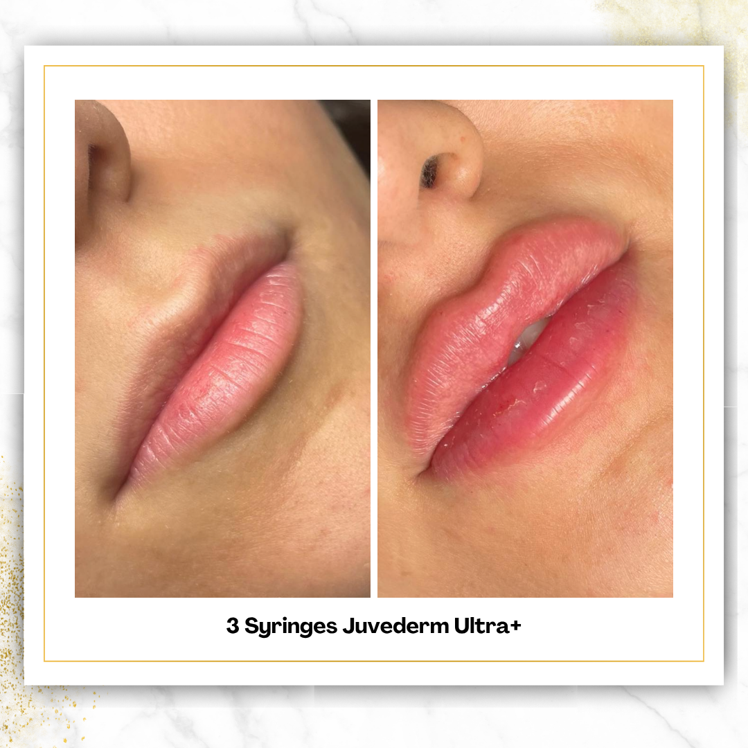 Juvederm Ultra+ in San Antonio | $525 Lip Filler | DaVida
