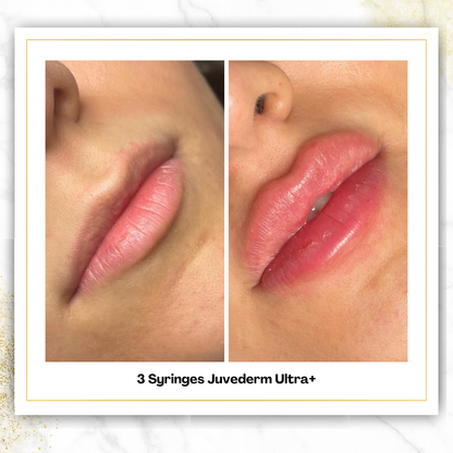Juvederm Ultra+ in San Antonio | $525 Lip Filler | DaVida