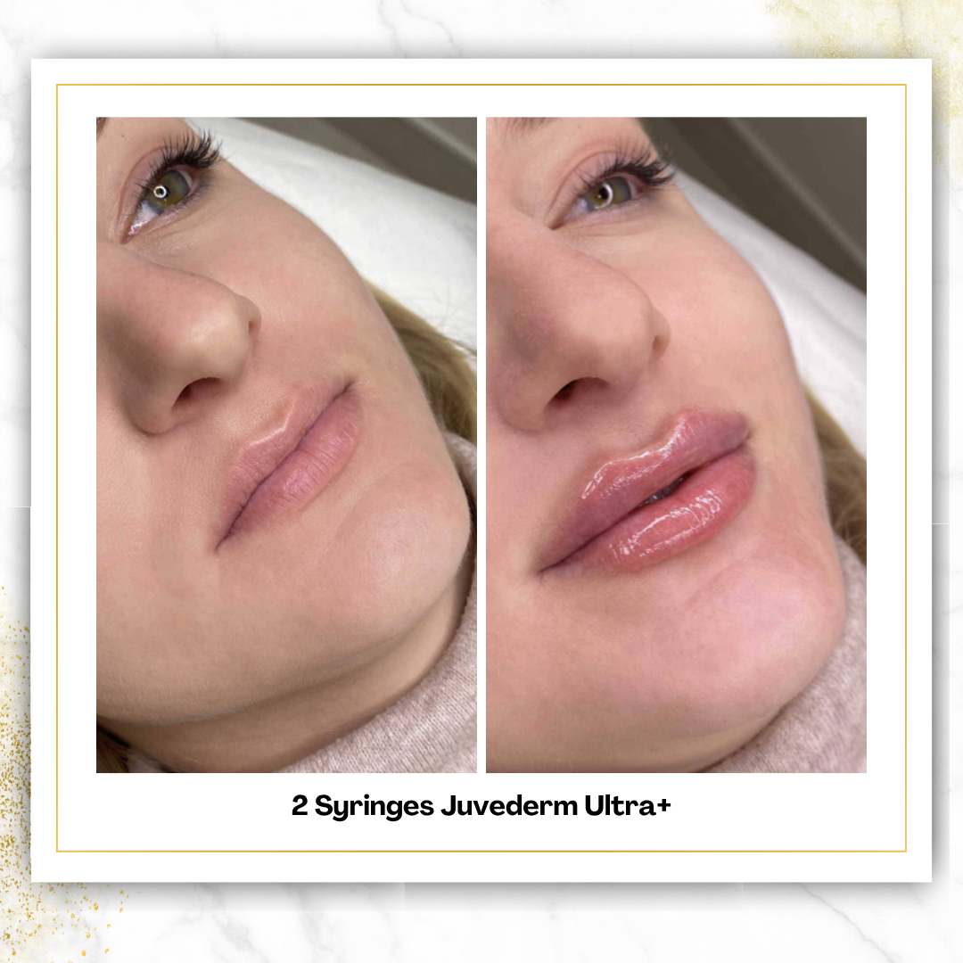 Juvederm Ultra+ in San Antonio | $525 Lip Filler | DaVida
