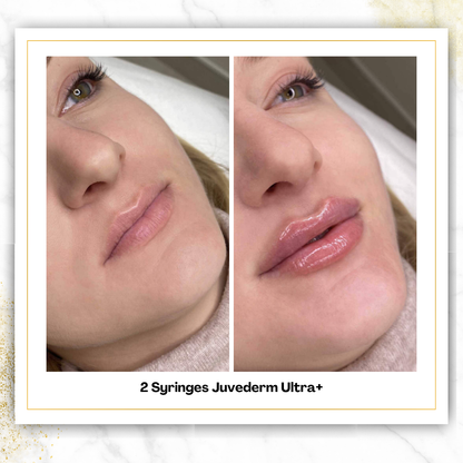 Juvederm Ultra+ in San Antonio | $525 Lip Filler | DaVida