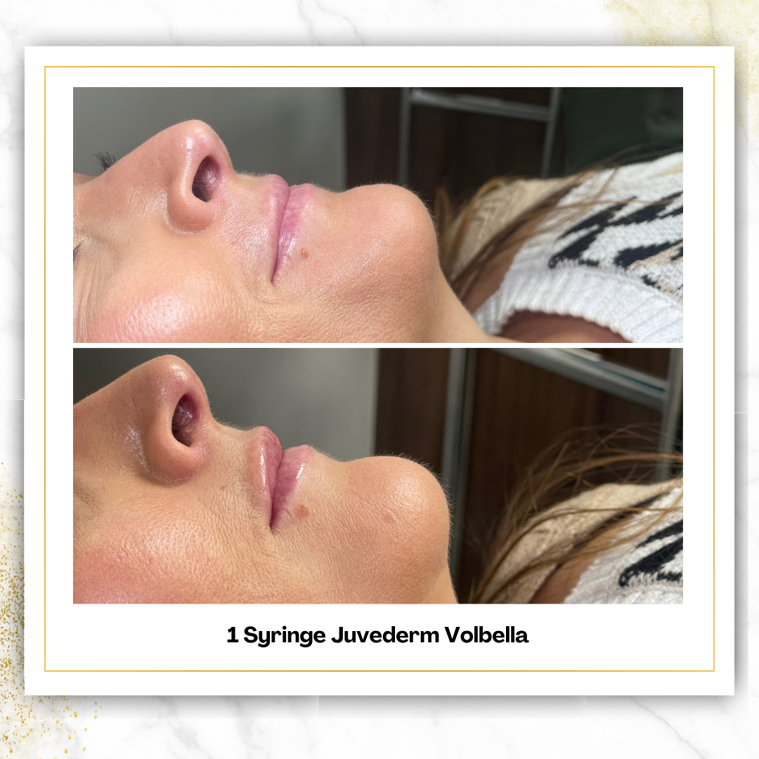 Juvederm Volbella in San Antonio | $650 Lip Filler