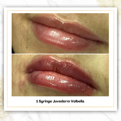 Juvederm Volbella in San Antonio | $650 Lip Filler