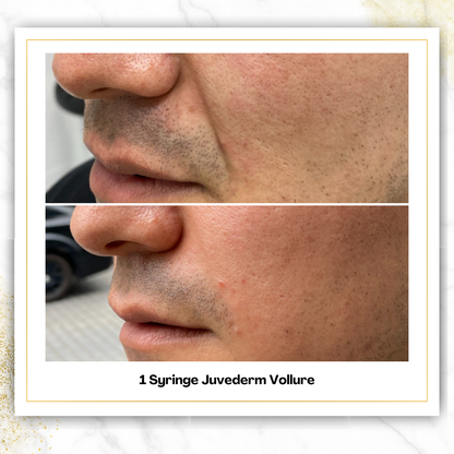 Juvederm Vollure in San Antonio | Laugh Line Filler
