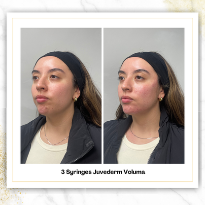 Juvederm Voluma Cheek Filler in San Antonio | DaVida
