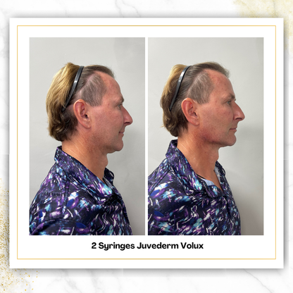 Juvederm Volux in San Antonio | Jawline Filler | $900
