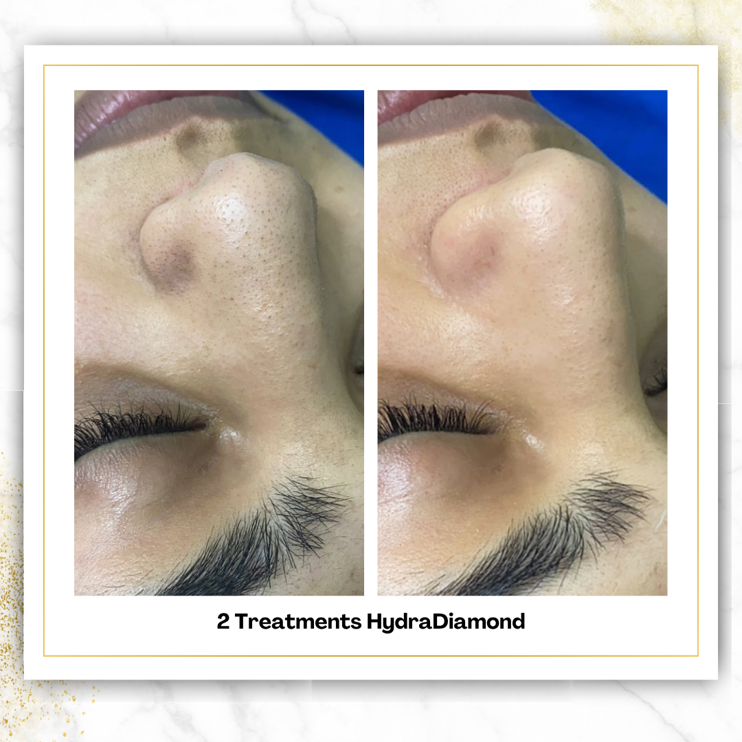 Hydrodiamond Treatment