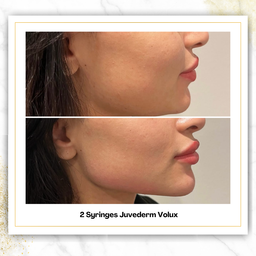 Juvederm Volux in San Antonio | Jawline Filler | $900