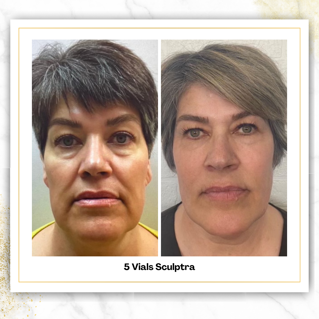 Sculptra in San Antonio | $750/Vial | DaVida Aesthetics