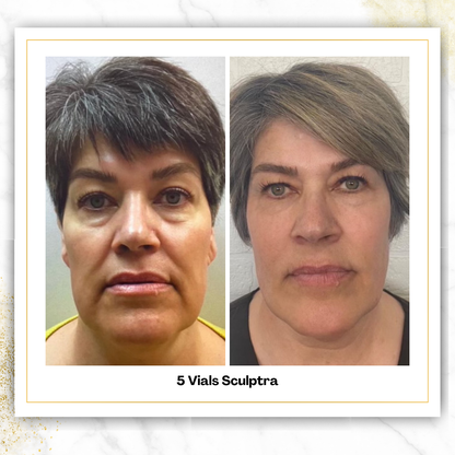 Sculptra in San Antonio | $750/Vial | DaVida Aesthetics