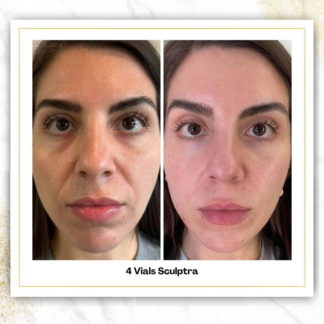 Sculptra in San Antonio | $750/Vial | DaVida Aesthetics