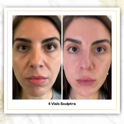 Sculptra in San Antonio | $750/Vial | DaVida Aesthetics