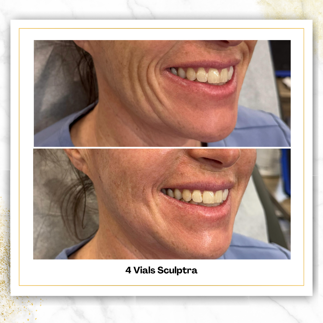 Sculptra in San Antonio | $750/Vial | DaVida Aesthetics