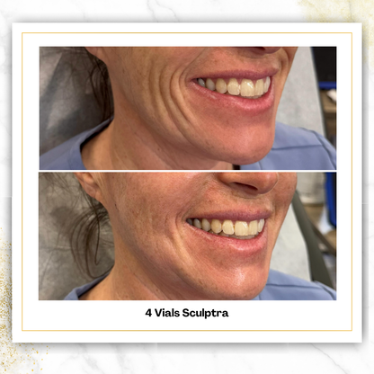 Sculptra in San Antonio | $750/Vial | DaVida Aesthetics