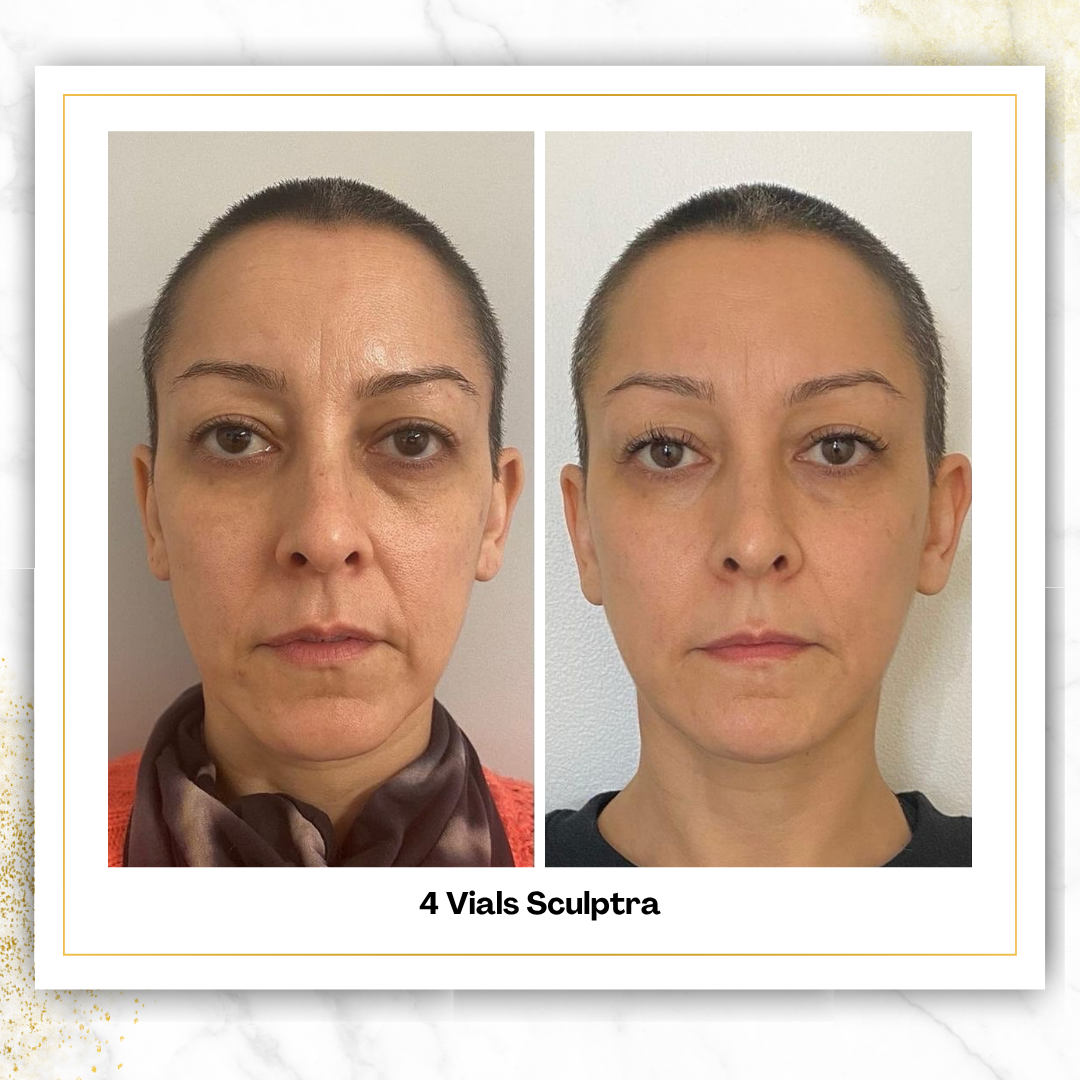 Sculptra in San Antonio | $750/Vial | DaVida Aesthetics