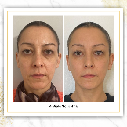 Sculptra in San Antonio | $750/Vial | DaVida Aesthetics