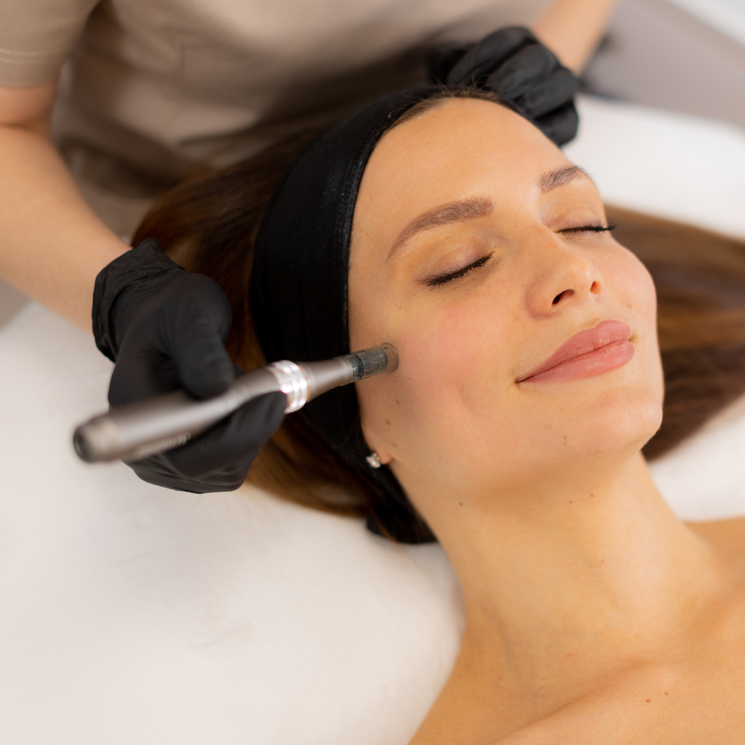 Vampire Facial in San Antonio | PRF + Microneedling | $850