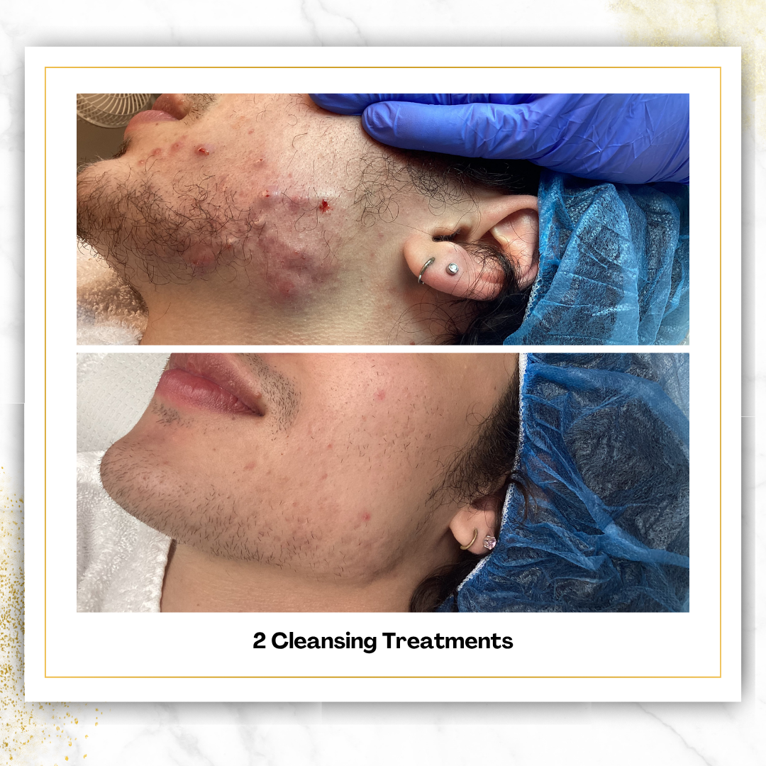 Cleansing Treatments in San Antonio | $75 | DaVida