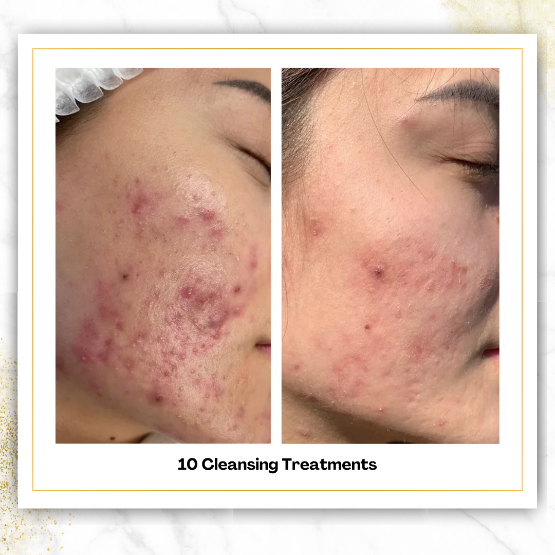 Cleansing Treatments in San Antonio | $75 | DaVida