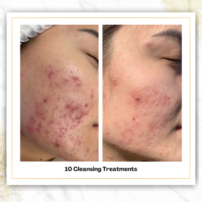 Cleansing Treatments in San Antonio | $75 | DaVida