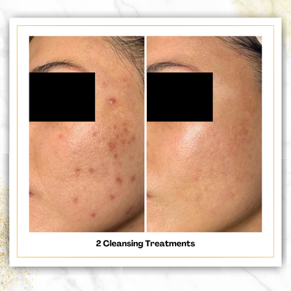 Cleansing Treatments in San Antonio | $75 | DaVida