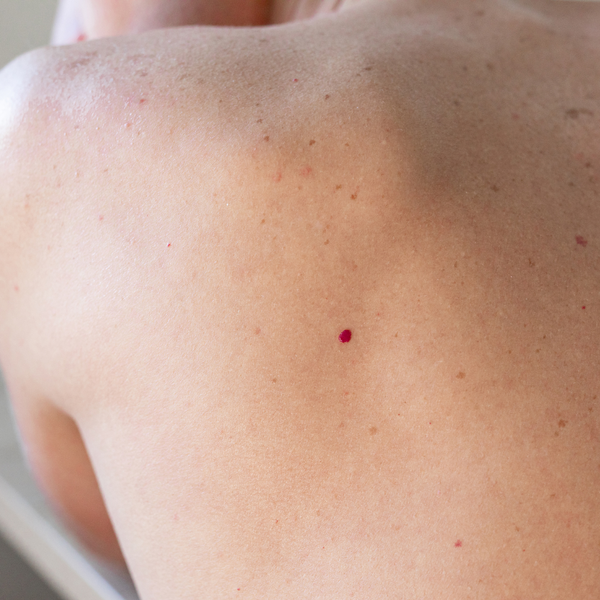 Cherry Angioma Removal in San Antonio | From $125