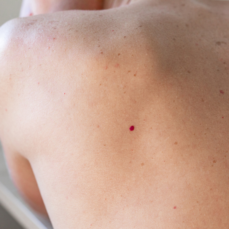 Cherry Angioma Removal