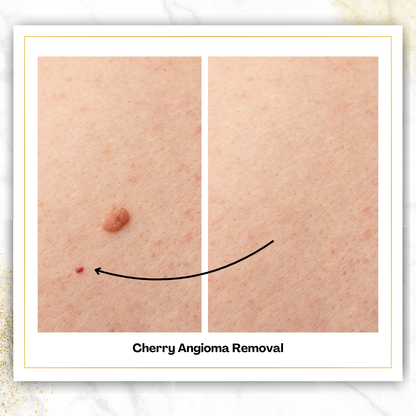 Cherry Angioma Removal in San Antonio | From $125