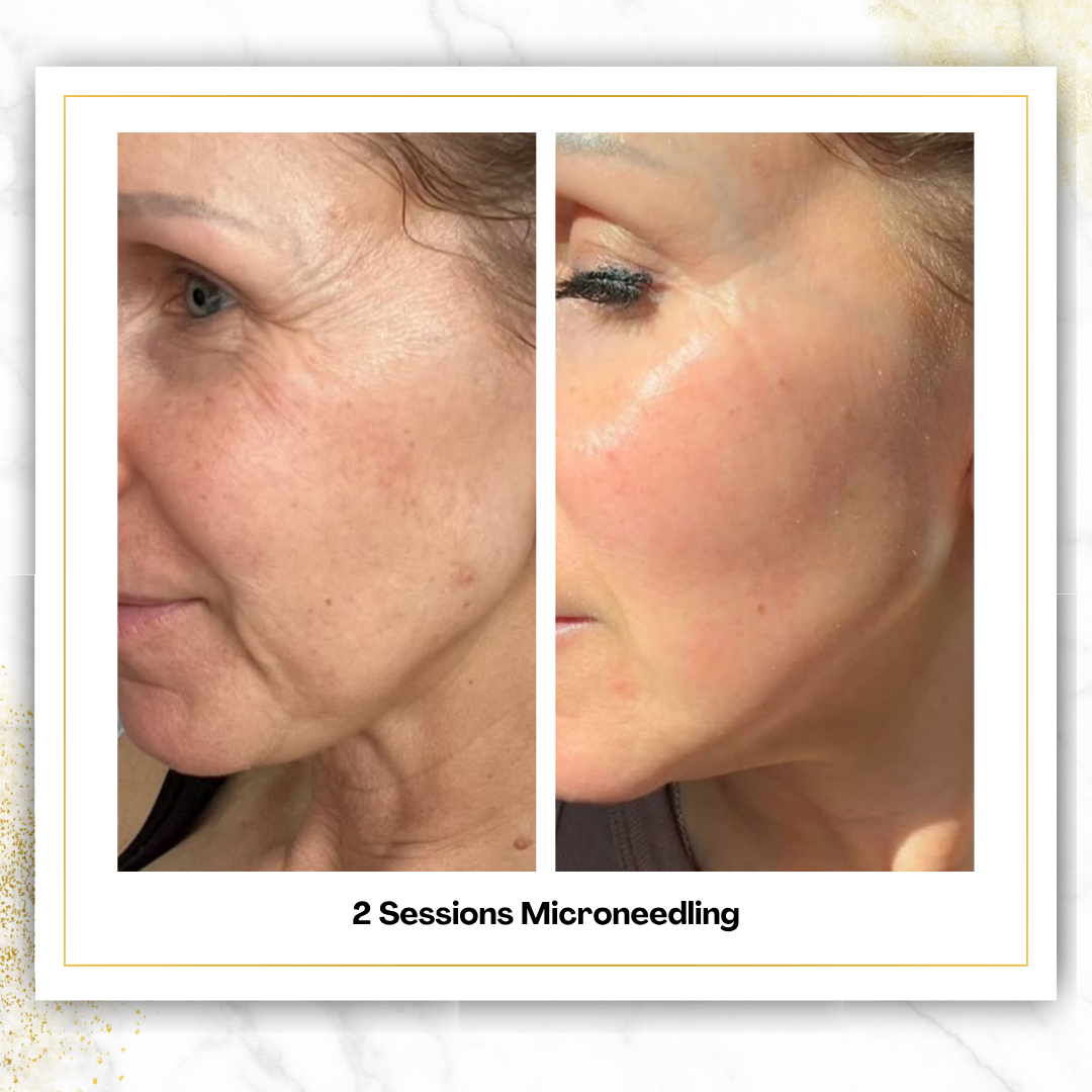 Microneedling in San Antonio | $300 | DaVida Aesthetics