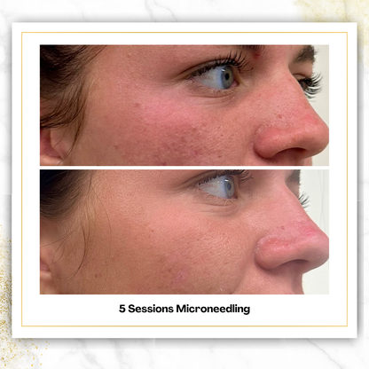 Microneedling in San Antonio | $300 | DaVida Aesthetics