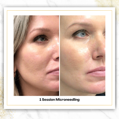 Microneedling in San Antonio | $300 | DaVida Aesthetics