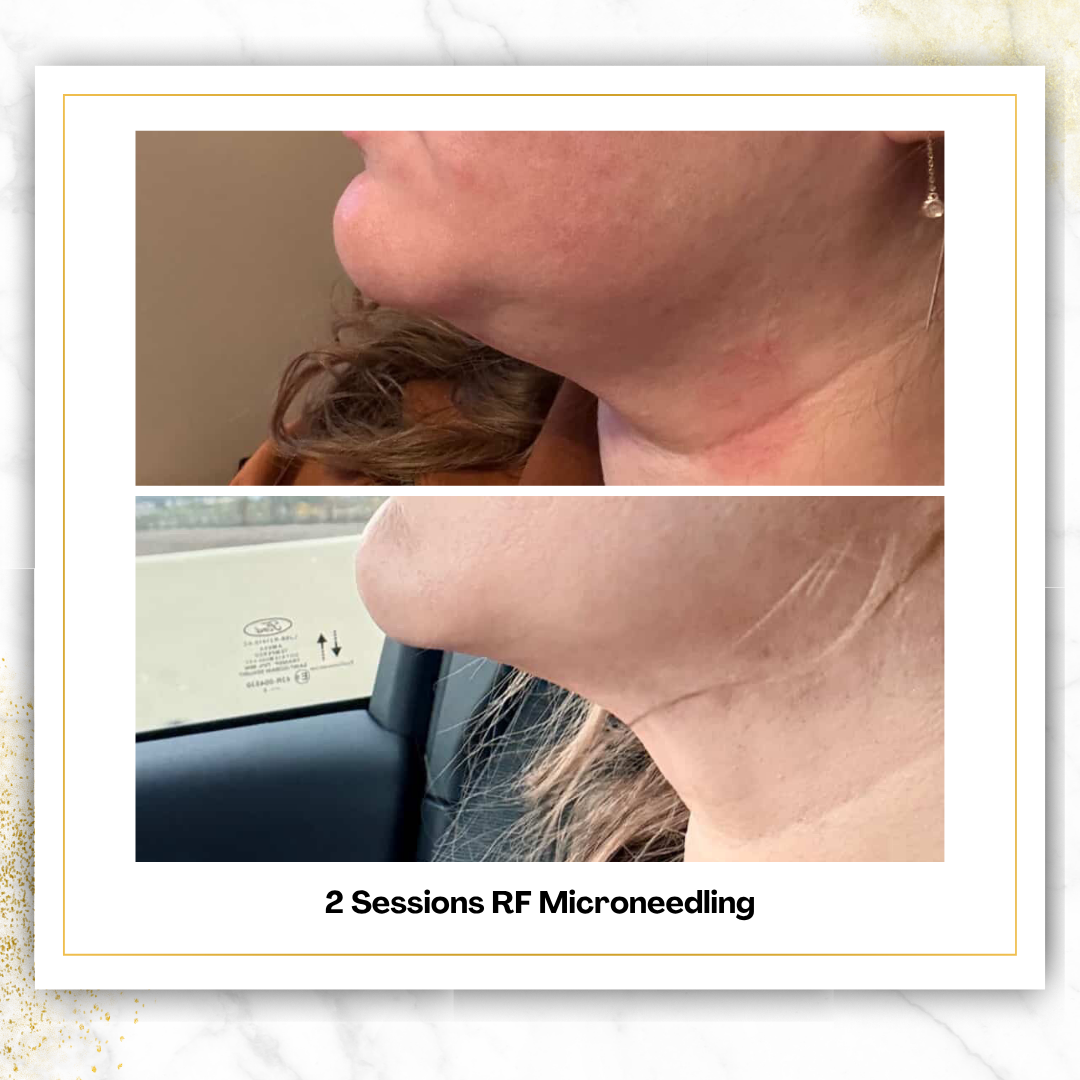 Matrix RF Microneedling in San Antonio | $1,000 | DaVida