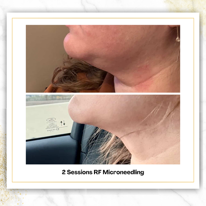 Matrix RF Microneedling in San Antonio | $1,000 | DaVida